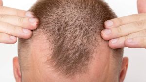 Regenera Activa Saç Tedavisi