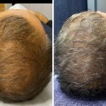 ExoSCRT Hair . Hair mesotherapy technique at 2 week intervals