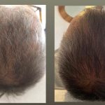 Applied with ExoSCRT Hair Hair Mesotherapy Technique